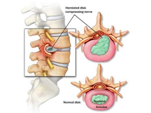 Nucleus Pulposus and How It Helps Your Spine