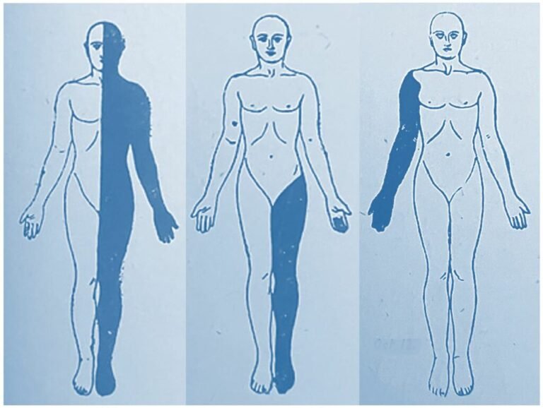 Numbness on One Side of the Body