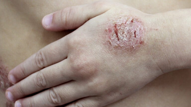 Nummular Eczema vs Ringworm_ Symptoms and How to Treat Them