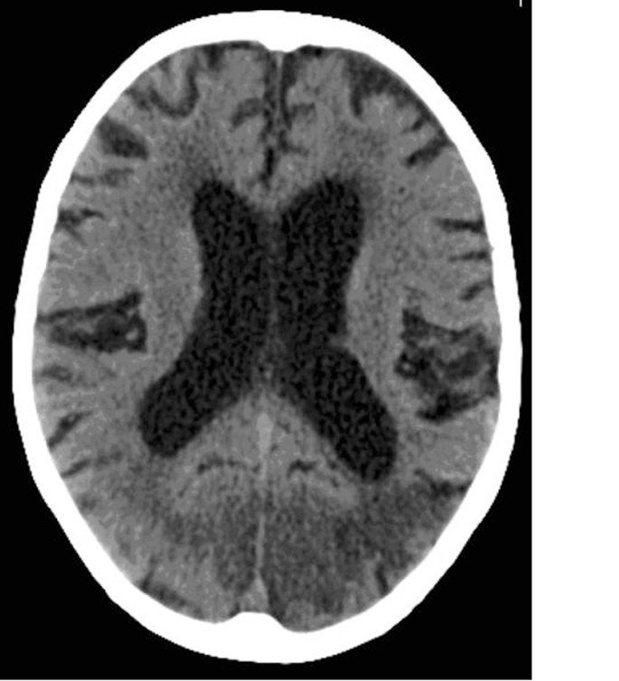 Occipital Stroke and Anton Syndrome