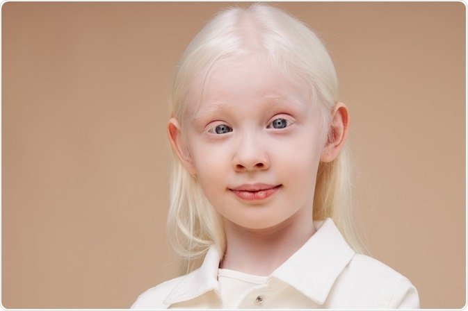Oculocutaneous Albinism