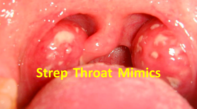 Negative Strep Throat Test_ What Else Mimics Strep_