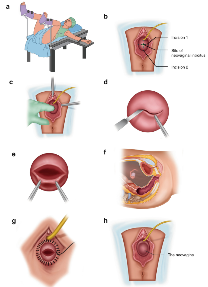 Neovagina Surgery_ Types of Vaginoplasty