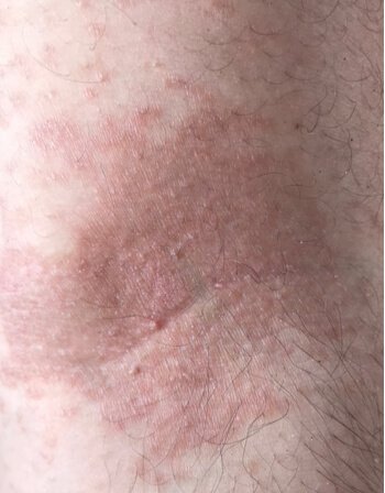 Neurodermatitis_ Causes, Symptoms, and Treatment