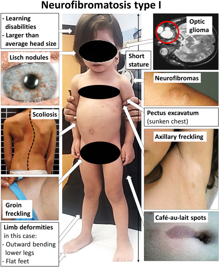 Neurofibromatosis Type 1 (NF1) and PN Tumor Complications