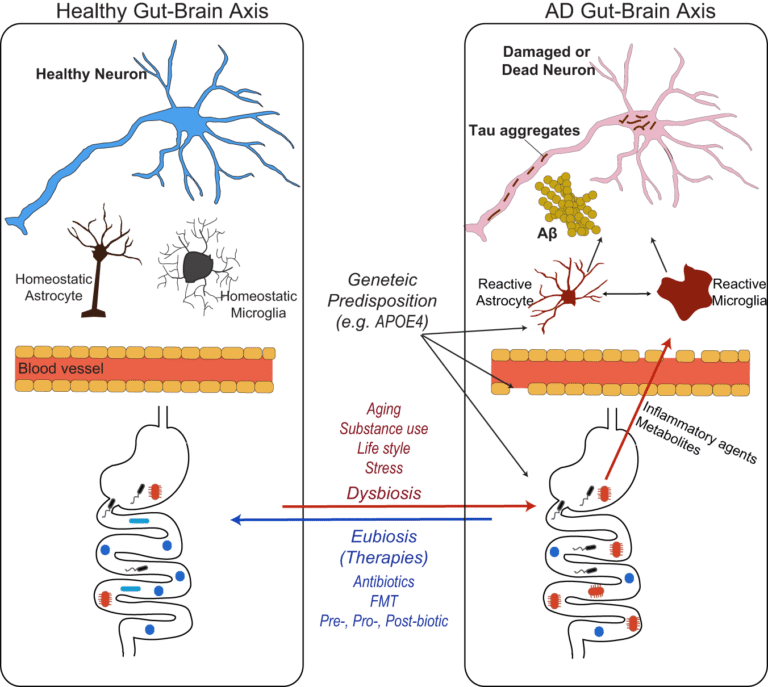 New Evidence Confirms Genetic Link Between Gut Health and Alzheimer’s