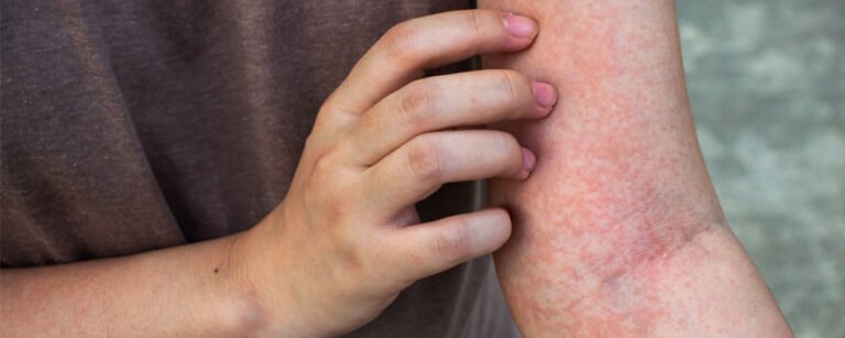Non-Blanching Rash_ Causes and When to Call a Healthcare Provider