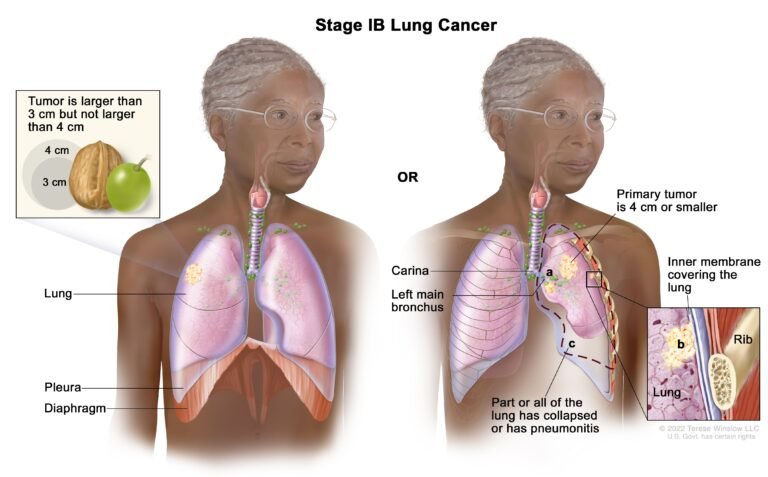 Non-Small Cell Lung Cancer Life Expectancy