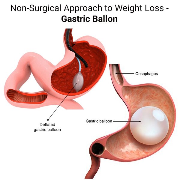 Nonsurgical Weight Loss Procedures and Bariatric Alternatives