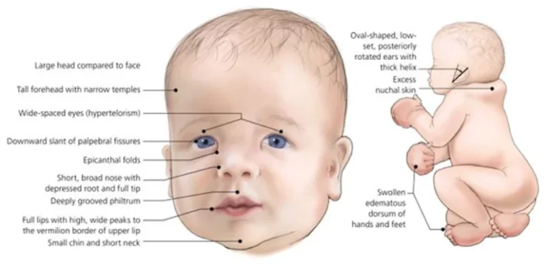 Noonan Syndrome